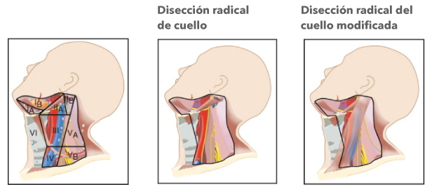 Disección radical del cuello Medellín